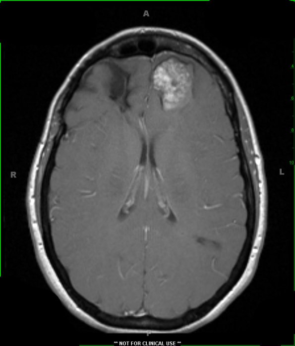 25A3 Cavernous Angioma (Case 25) T1 W 2 - Copy