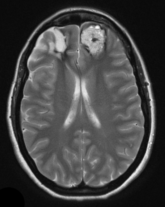 25A4 Cavernous Angioma (Case 25) T2 3 - Copy