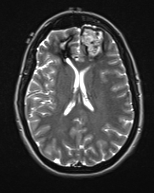 25A5 Cavernous Angioma (Case 25) T2 W 1 - Copy