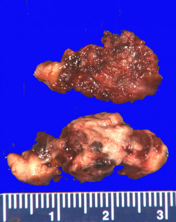 25B Cavernous angioma (Case 25) Gross