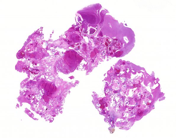 25C1 Cavernous Angioma (Case 25) H&E whole mount1