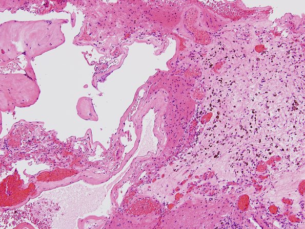 25C4 Cavernous Angioma (Case 25) H&E 2