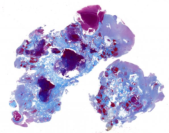 25D1 Cavernous Angioma (Case 25) Trichrome WM