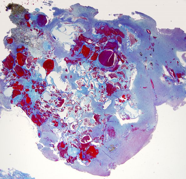 25D2 Cavernous angioma (Case 25) Trichrome 1 2X