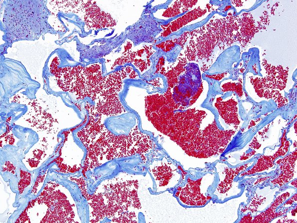 25D3 Cavernous Angioma (Case 25) Trichrome 3