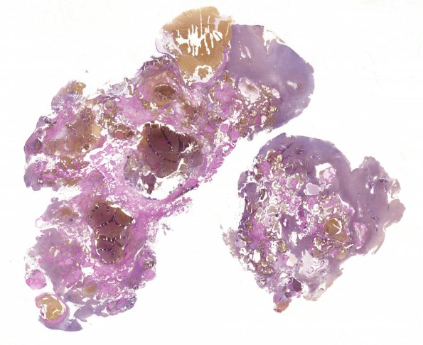 25E1 Cavernous Angioma (Case 25) VVG WM