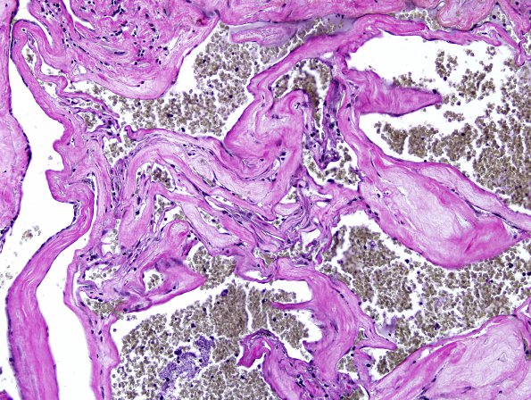 25E2 Cavernous Angioma (Case 25) VVG 2