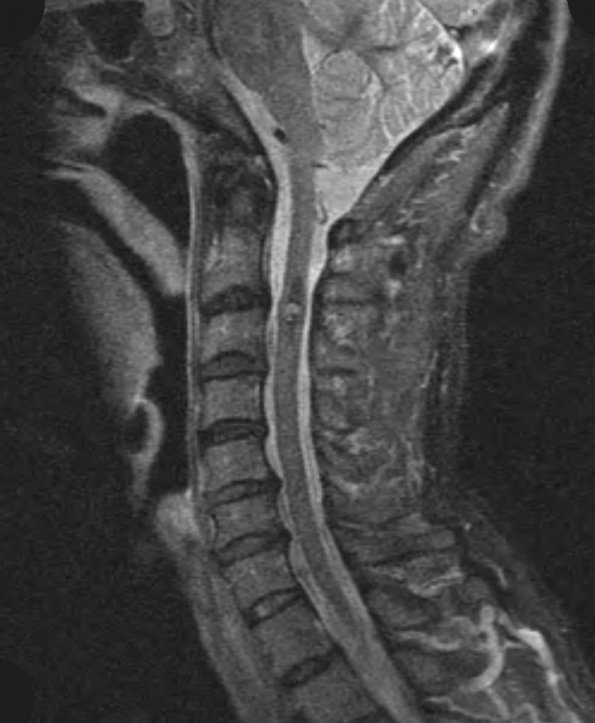 26A1 Cavernous Hemangioma (Case 26) T2 3 - Copy