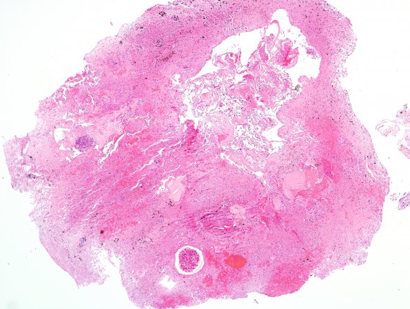 26B1 Cavernous Hemangioma (Case 26) H&E 4