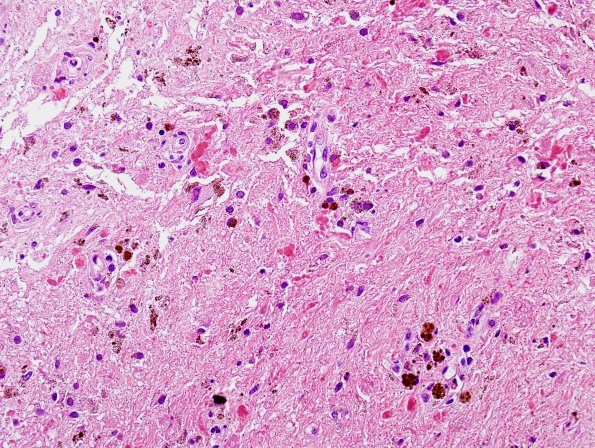 26B2 Cavernous Hemangioma (Case 26) H&E 3