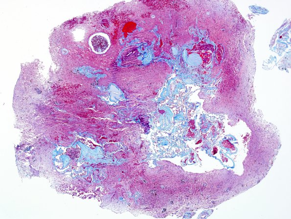 26C1 Cavernous Hemangioma (Case 26) Trichrome 3