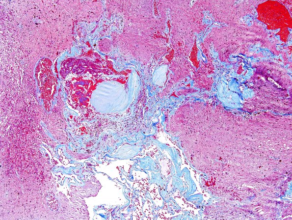 26C2 Cavernous Hemangioma (Case 26) Trichrome 2