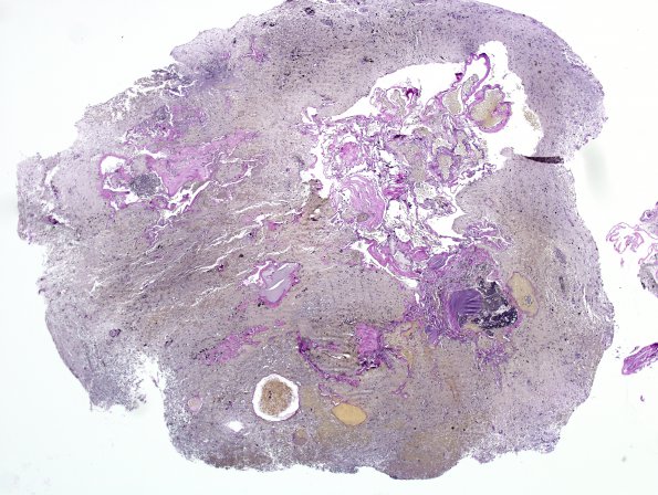 26D1 Cavernous Hemangioma (Case 26) VVG 2