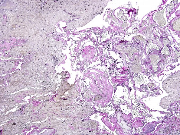 26D2 Cavernous Hemangioma (Case 26) VVG 1