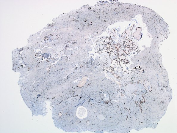 26E Cavernous Hemangioma (Case 26) SMA 2