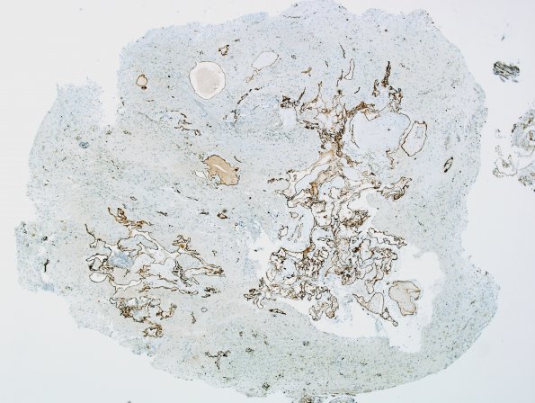 26F Cavernous Hemangioma (Case 26) CD34 3