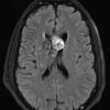 27A1 Cavernous angioma (Case 27) TIRM - Copy