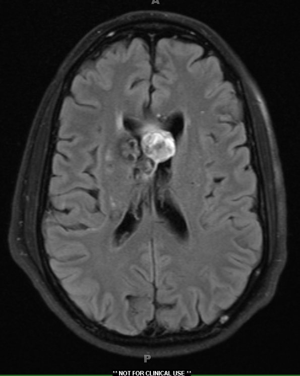 27A1 Cavernous angioma (Case 27) TIRM - Copy