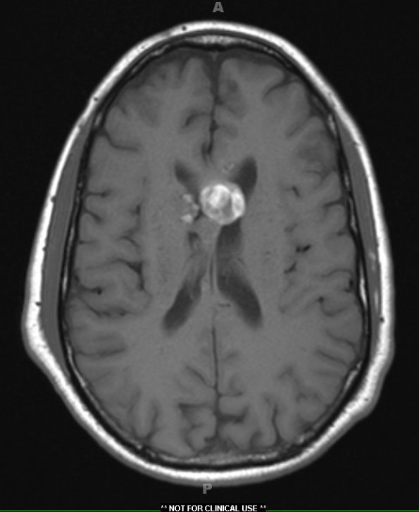 27A2 Cavernous angioma (Case 27) T1 2 - Copy