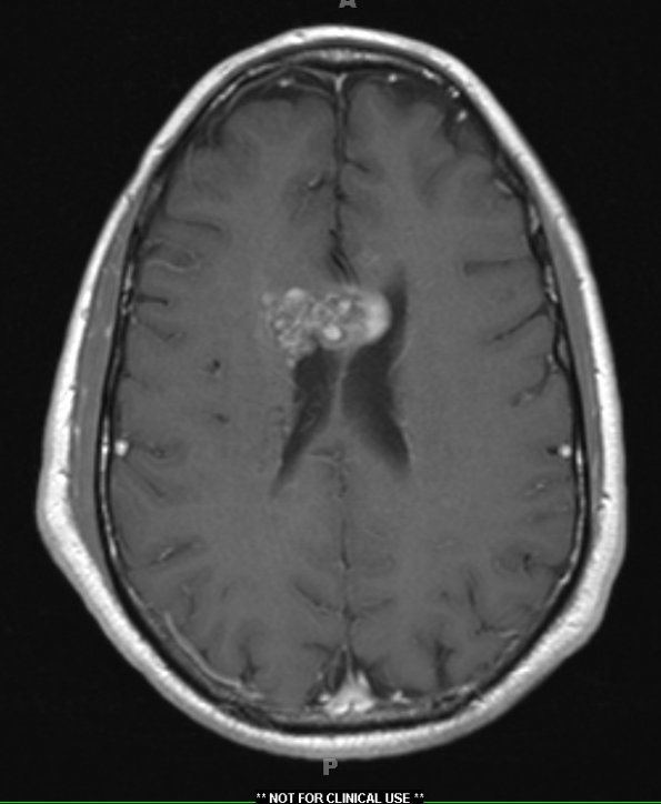 27A3 cavernous angioma (Case 27) T1W 1 - Copy