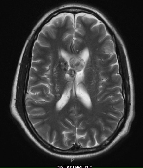 27A4 Cavernous angioma (Case 27) T2W 1 - Copy