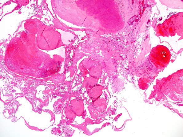 27B Cavernous angioma (Case 27) H&E 3