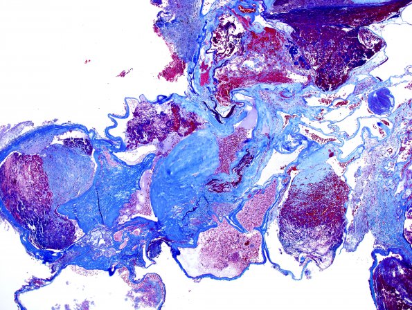 27C Cavernous angioma (Case 27) Trichrome