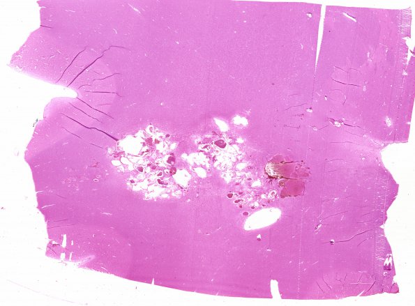 28B1 1Cavernoma (Case 28) G H&E WM