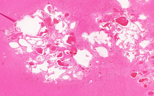 28B2 Cavernoma  (Case 28) G H&E 2X