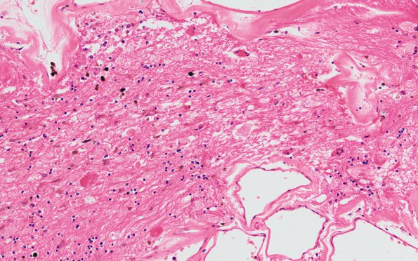 28B3 Cavernoma  (Case 28) G H&E 20X