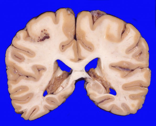 29A1 Infarct, subacute (DDx VA or CA) (Case 29) 2