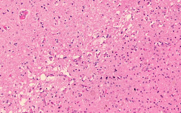 29B2 Infarct, subacute (DDx VA or CA) (Case 29) H&E 20X