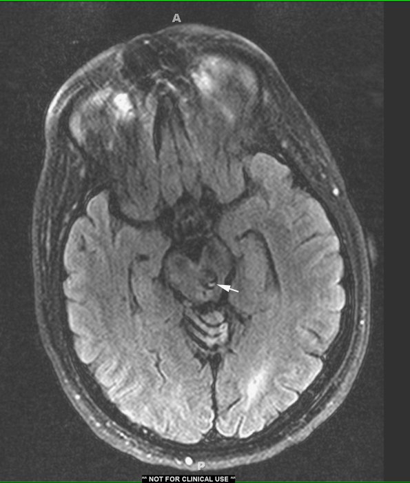 2A1 Cavernous Angioma (Case 2) FLAIR 1 copy - Copy