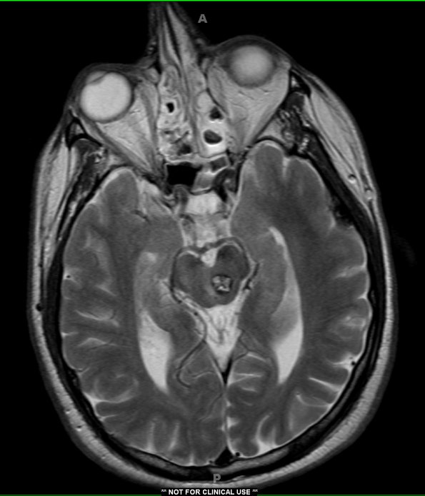 2A2 Cavernous Angioma (Case 2) T2 no contrast 2A - Copy