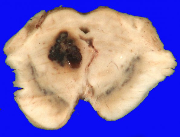 2B1 Cavernoma (Case 2) 1