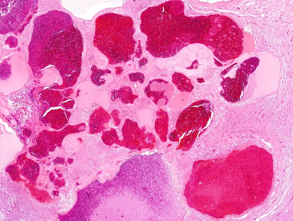 2C2 Cavernoma (Case 2) H&E 1