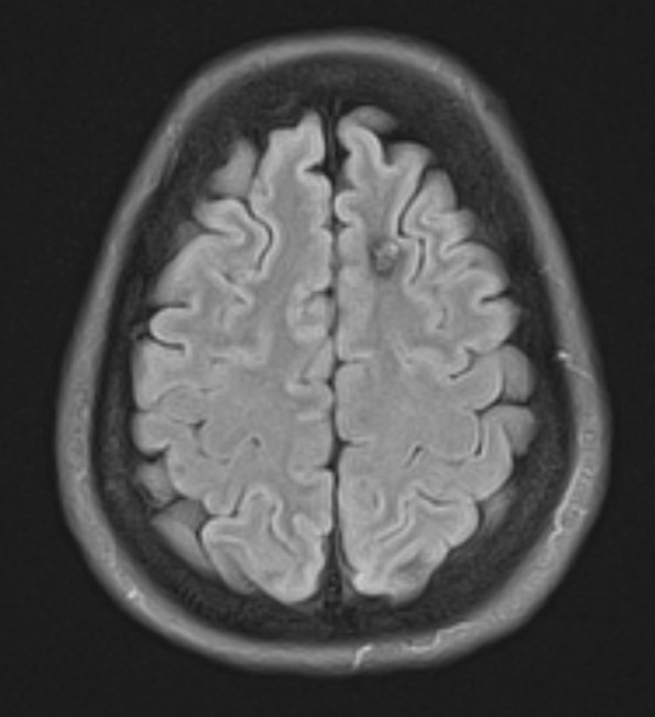 30A1 Cavernous angioma (Case 30) FLAIR 1 - Copy