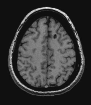 30A2 Cavernous angioma (Case 30) T1NoC - Copy