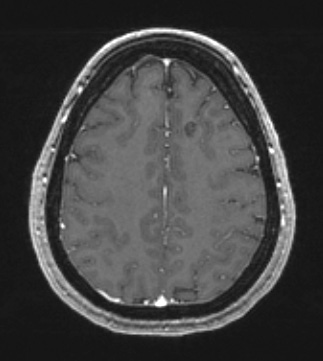 30A3 Cavernous angioma (Case 30) T1W - Copy
