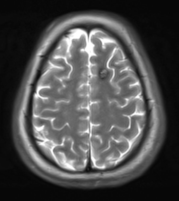 30A4 Cavernous angioma (Case 30) T2 1 - Copy