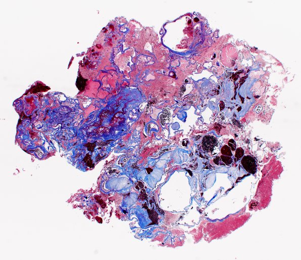 30D Cavernous angioma (Case 30) TRI 2X