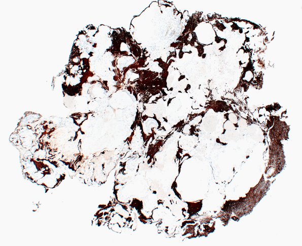 30E Cavernous angioma (Case 30) SMA 2X