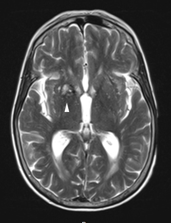 31A Cavernoma (Case 31) T2noC copy - Copy