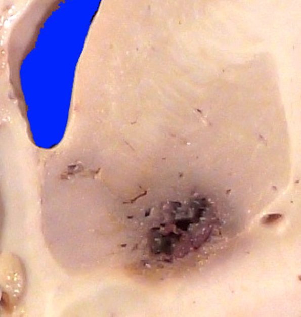 31B2 Cavernoma (Case 31) 1_2