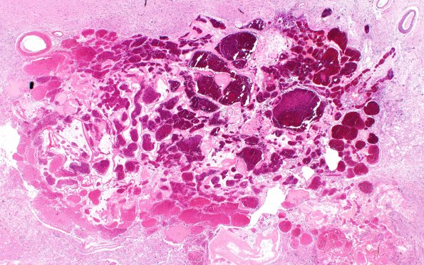 31C2 Cavernoma (Case 31) H&E 2X