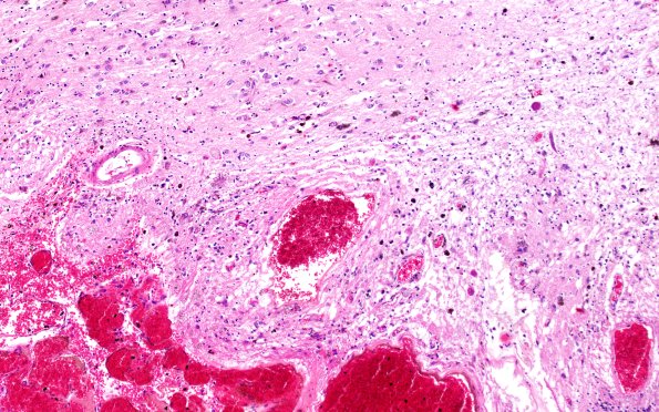 31C5 Cavernoma (Case 31) H&E 10X