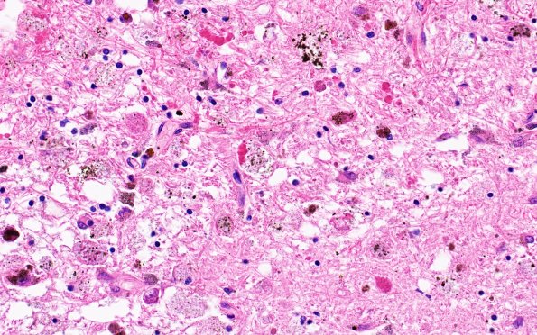 31C6 Cavernoma (Case 31) H&E 40X 2