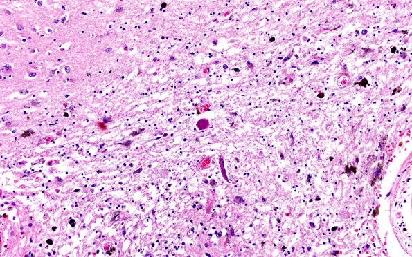 31C7 Cavernoma (Case 31) H&E 20X