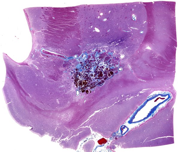 31D1 Cavernoma (Case 31) TRI WM