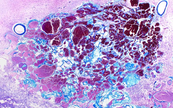 31D2 Cavernoma (Case 31) Trichrome AA